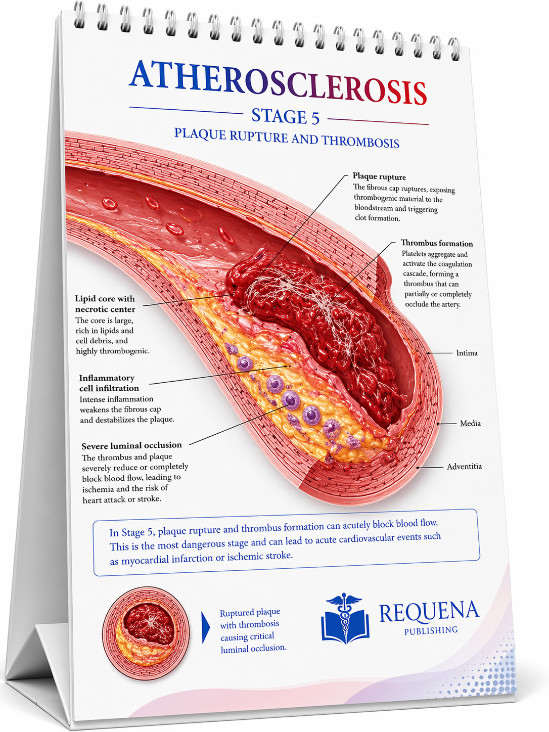 Atherosclerosis stage 5 medical flip chart