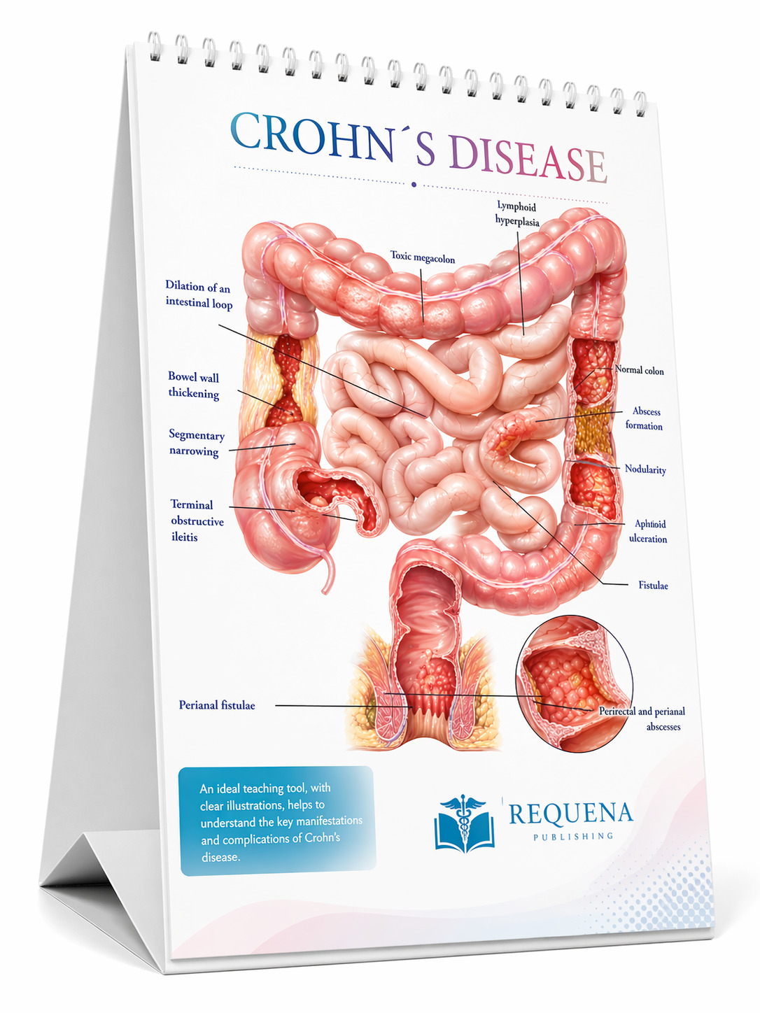 Crohn's disease medical flip chart