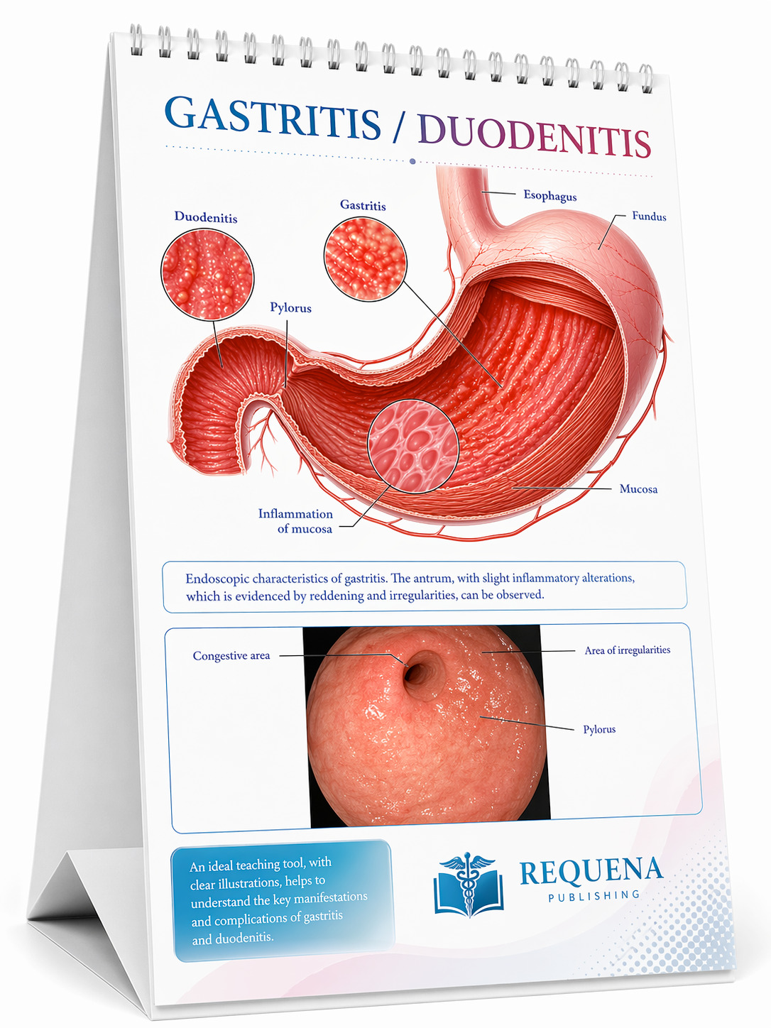 Gastritis and duodenitis medical flip chart