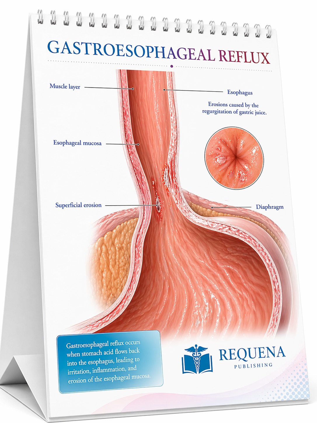 Gastroesophageal reflux medical flip chart