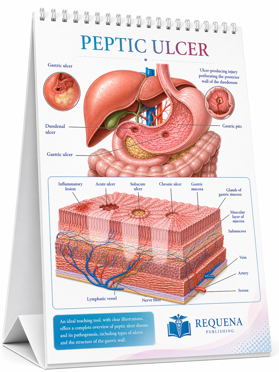 Peptic ulcer medical flip chart